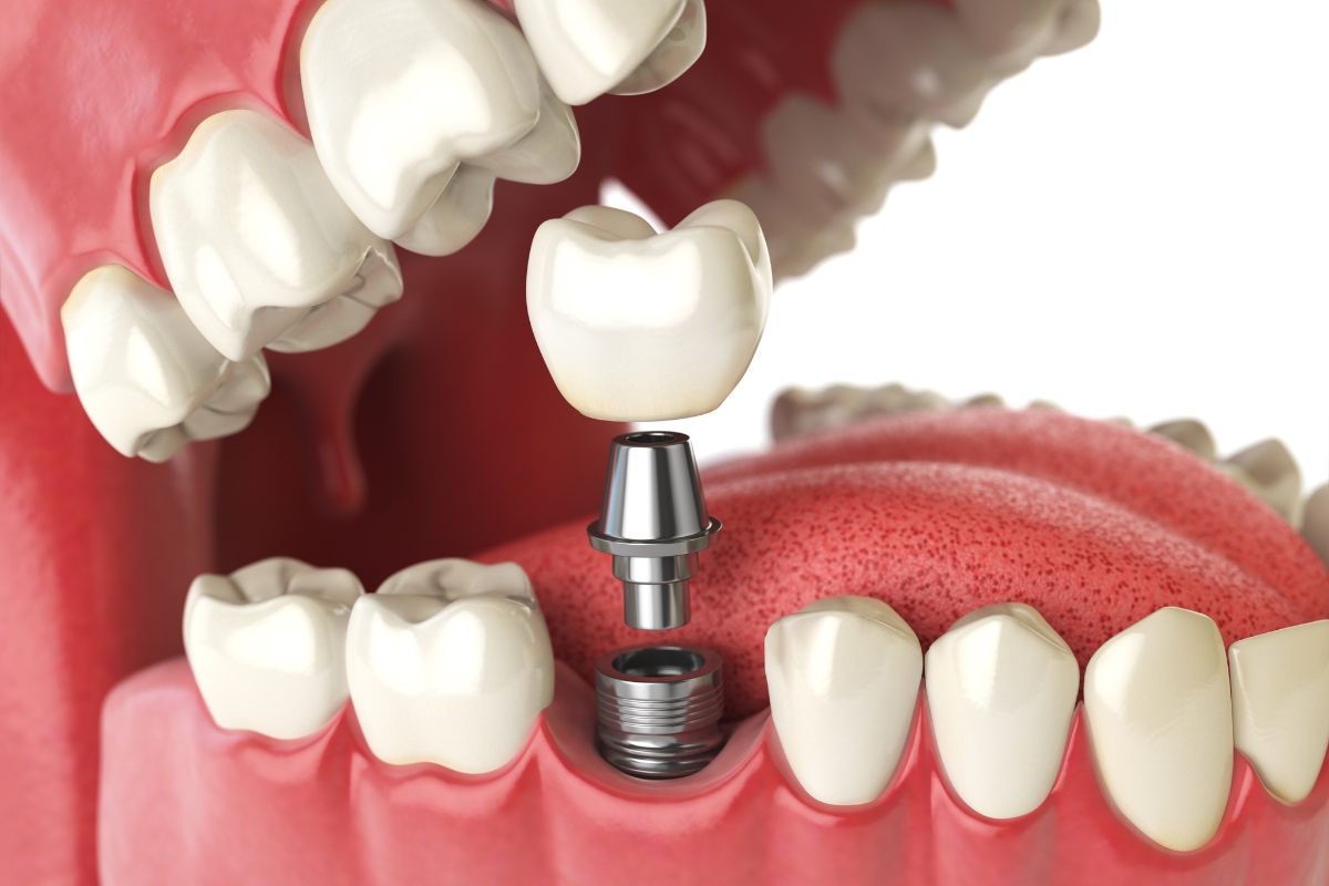why dental implants are ideal for missing teeth a guide for boynton beach residents